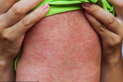 BÀI TUYÊN TRUYỀN PHÒNG BỆNH GIAO MÙA CHO TRẺ MẦM NON